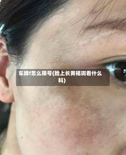 车牌f怎么限号(脸上长黄褐斑看什么科)
